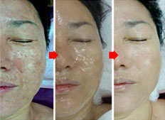 面膜 使用前->面膜涂抹后->面膜使用后(3周后)