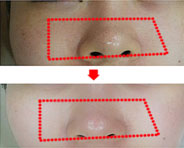面膜 使用前   面膜涂抹后    面膜使用后(3周后)